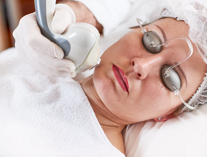 Laserbehandlung im Gesicht mit Titanlaser, LaserGenesis, Limelight Laser zur Hautstraffung und Verjüngung