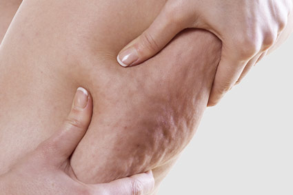 Cellulite Behandlung