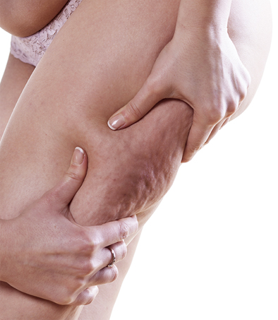 was hilft gegen Cellulite?