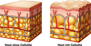 cellulite behandlung