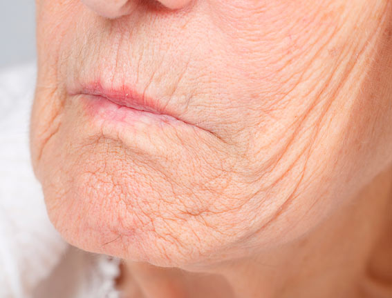 Gentle skin tightening