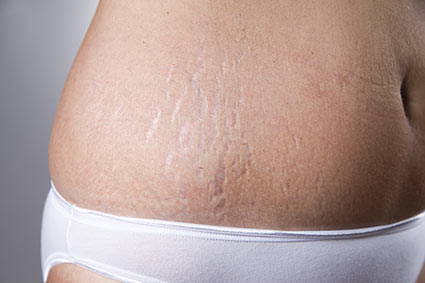 Schwangerschaftsstreifen Dehnungsstreifen Microneedling