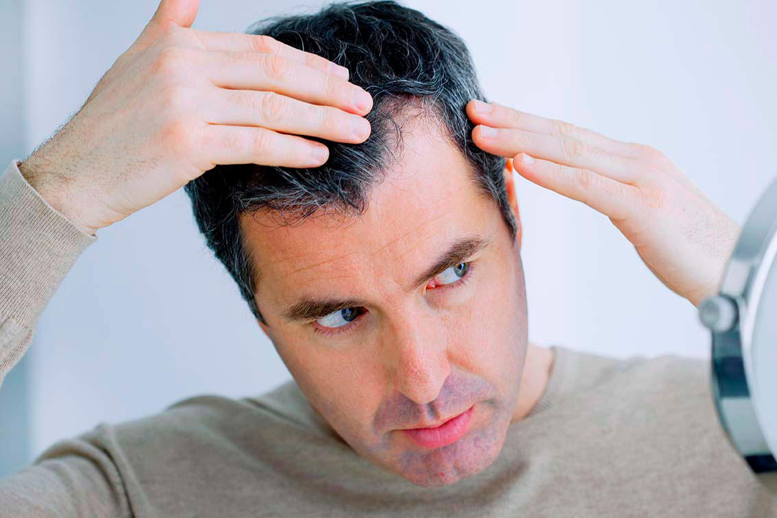 Anlagebedingter Haarausfall: Ursache und erfolgreiche Behandlung.