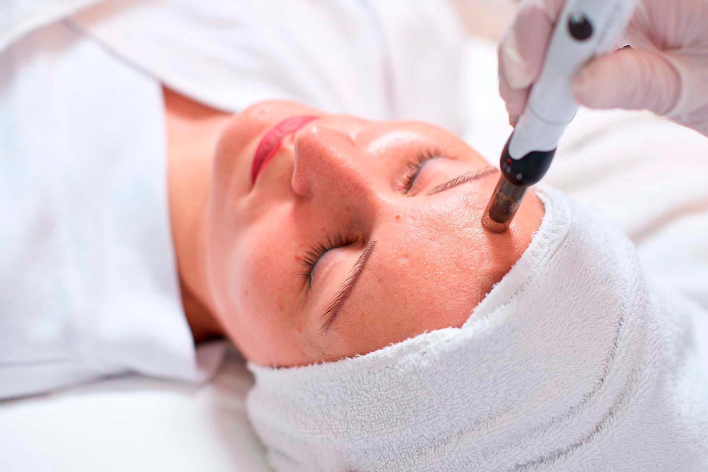 Die Herbstzeit ist Microneedling-Zeit!