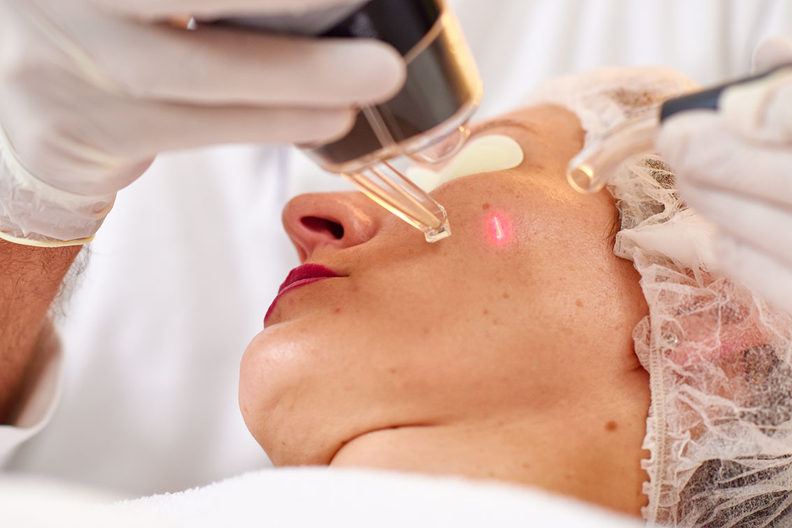 Im Trend: Minimal-invasives  Anti-Aging mit Laser