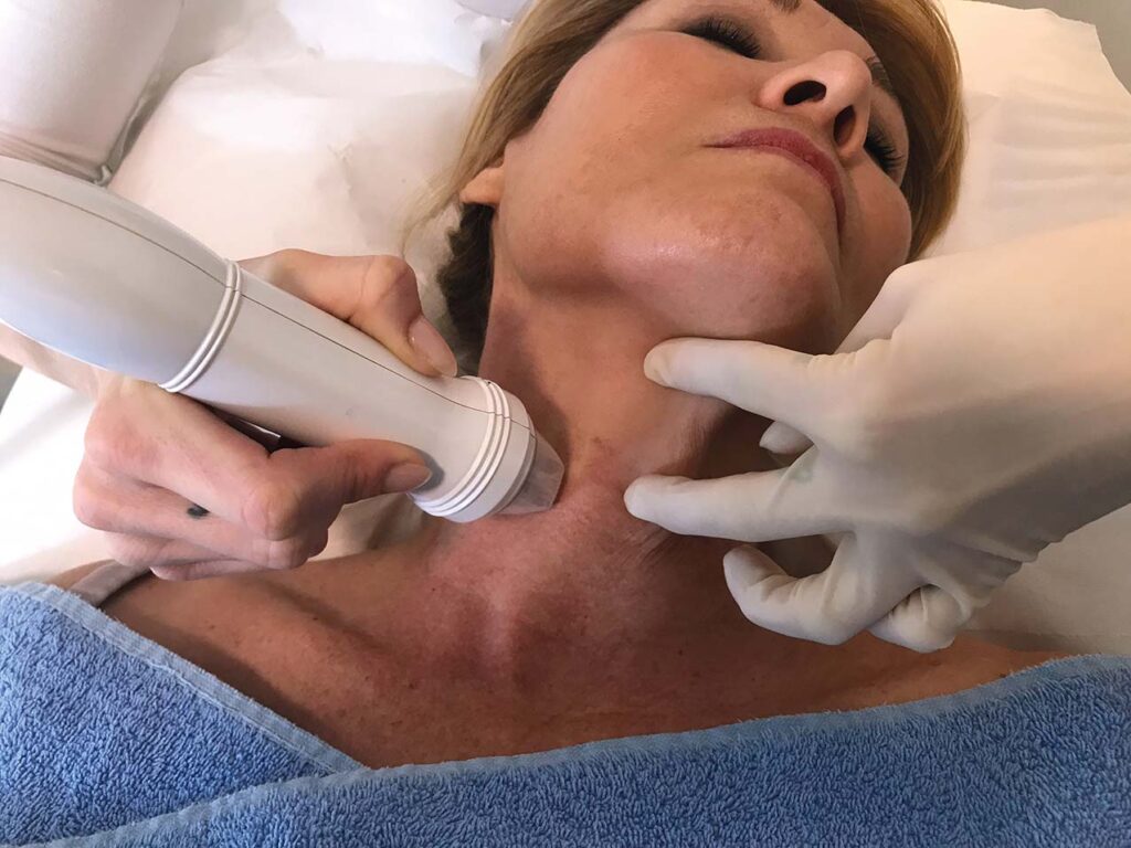 Radiofrequenz Microneedling