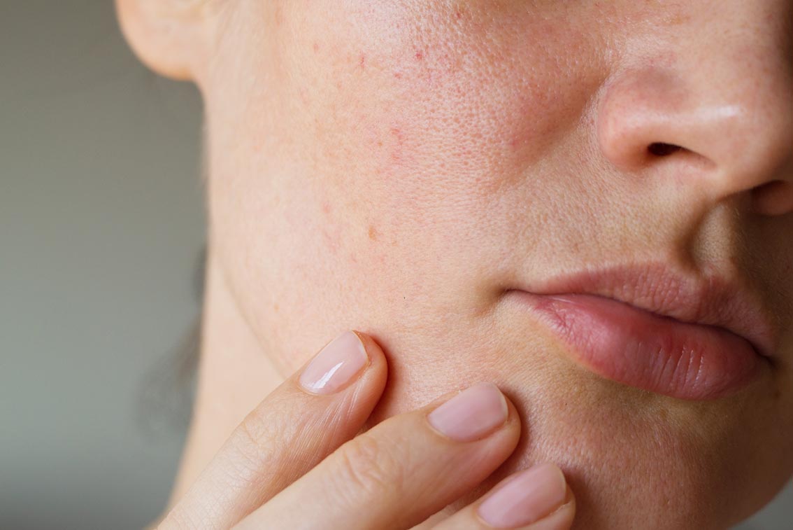 Grosse Poren – Was kann man dagegen tun?